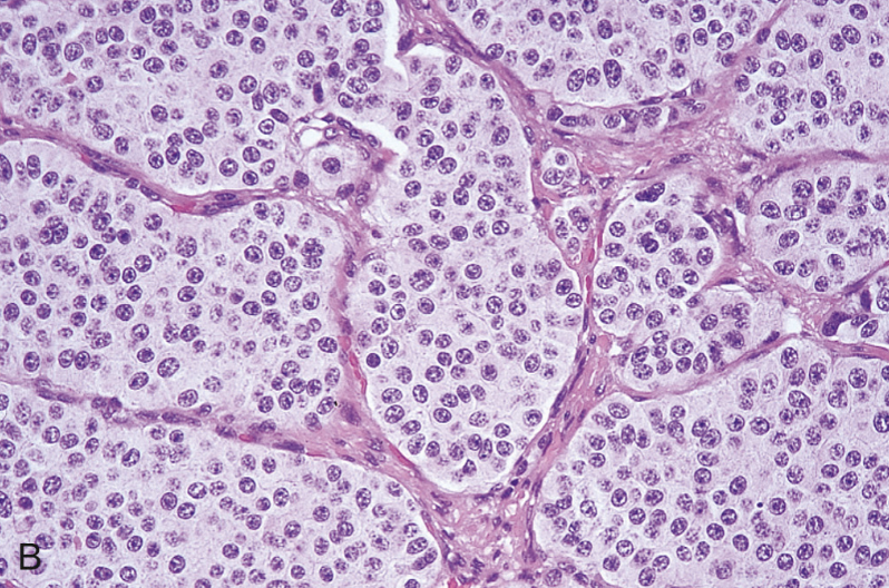 <p>Tumores carcinoides microscopicamente</p>