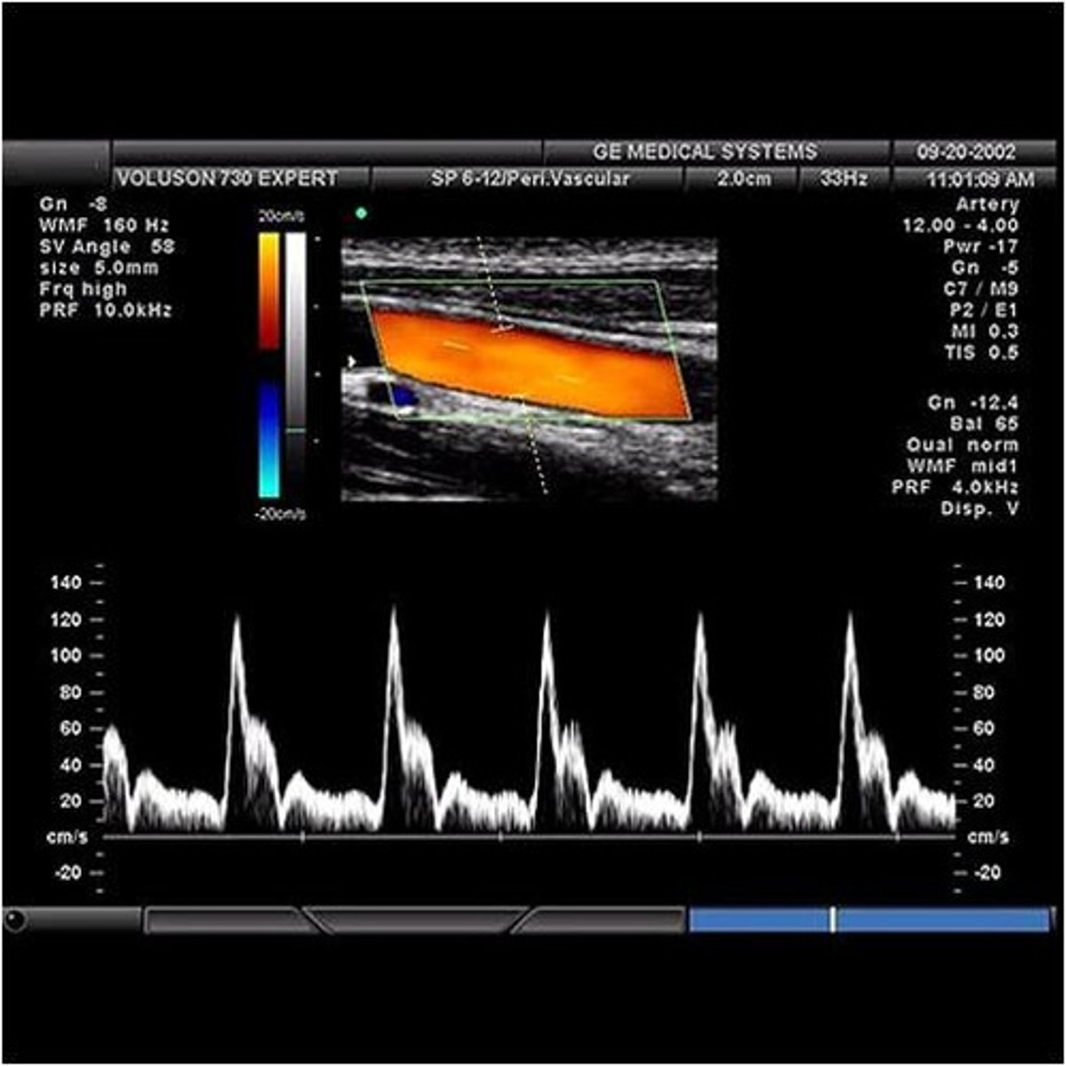 <p>small downward deflection in the arterial pulse (pressure wave) immediately after the closure of the semi-lunar valves</p>
