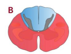<p>Describe the effects of this lesion</p>