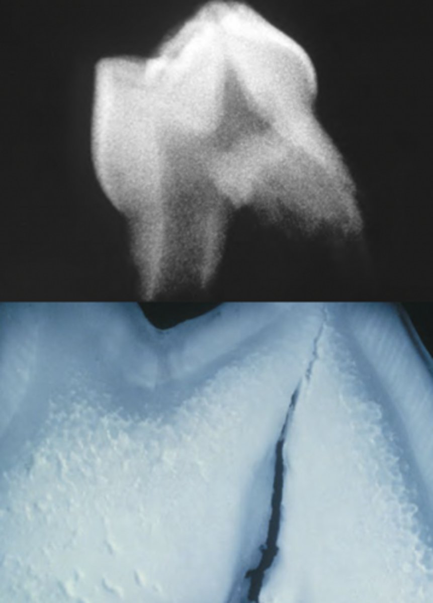 <p>-large pulp chambers w/ pulp horns extending to DEJ</p><p>-cuspal enamel may be worn down by attrition causing pulpal exposure</p>