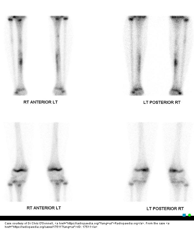 <p>What causes tibial stress fractures?</p>