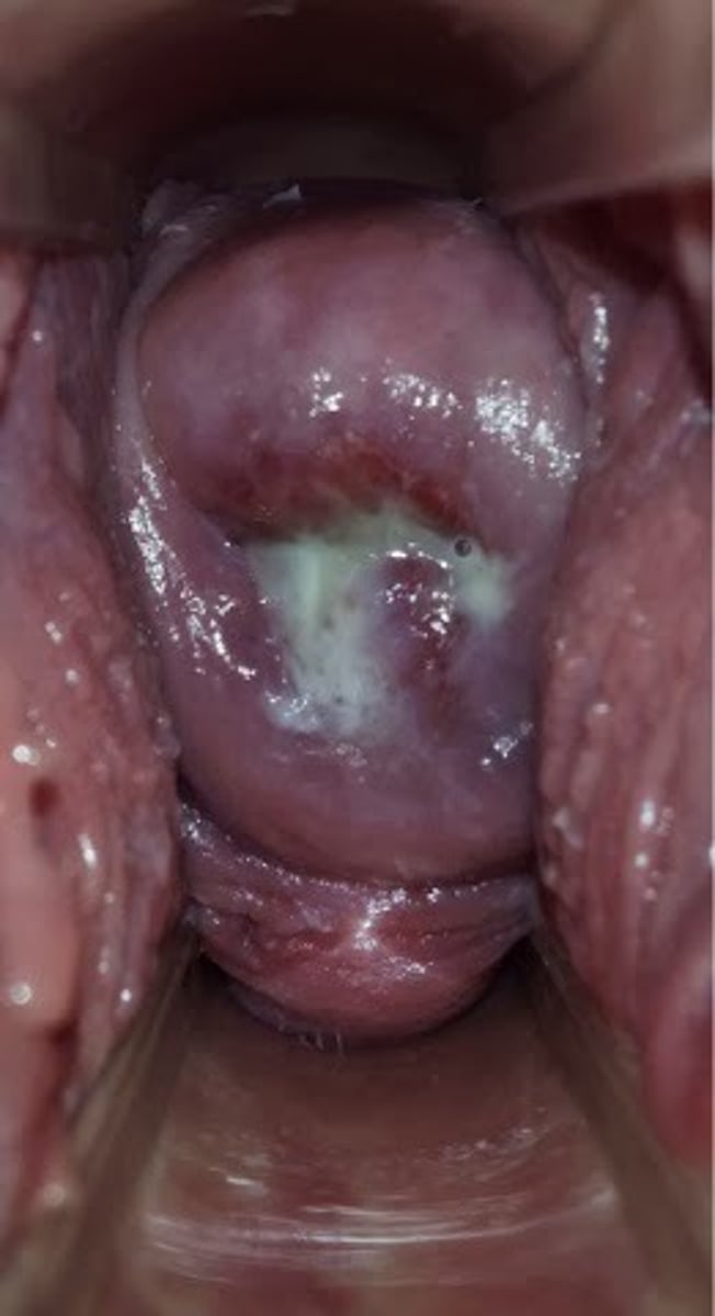 <p>Bluish purple discoloration of the cervix, vagina, and labia during pregnancy as a result of increased vascular congestion.</p>