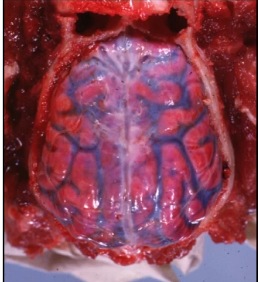 <p>what type of hemorrhage is this?</p>