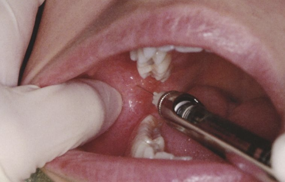<ul><li><p>Landmarks: coronoid notch (greatest concavity on the anterior border of the ramus); pterygomandibular raphe (vertical portion); occlusal plane of the mandibular teeth</p></li></ul><p></p>