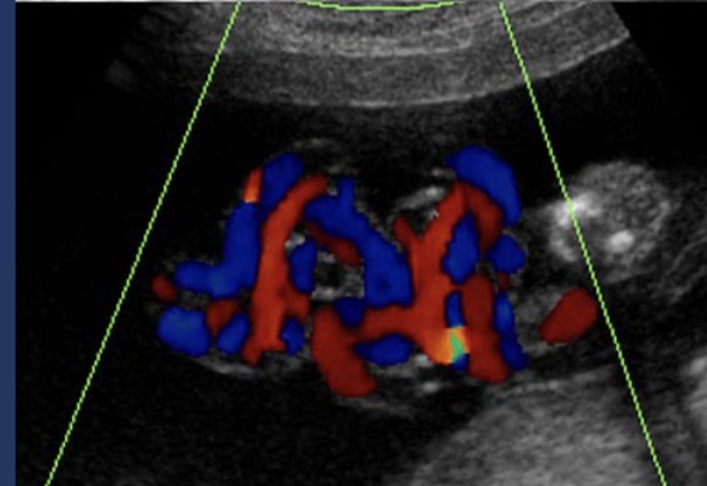 <p>Occurs only in monochorionic monoamniotic twins</p><p>50% compromise blood flow - end in fetal demise</p>