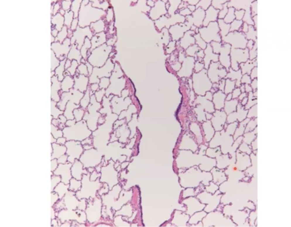 If normal lung tissue looks like this → 

How does emphysema look? 