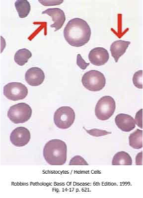 <p>What does this refer to</p><ul><li><p>Schistocytes</p></li><li><p>Tear drop cells</p></li><li><p>Increased reticulocytes</p></li></ul><p></p>