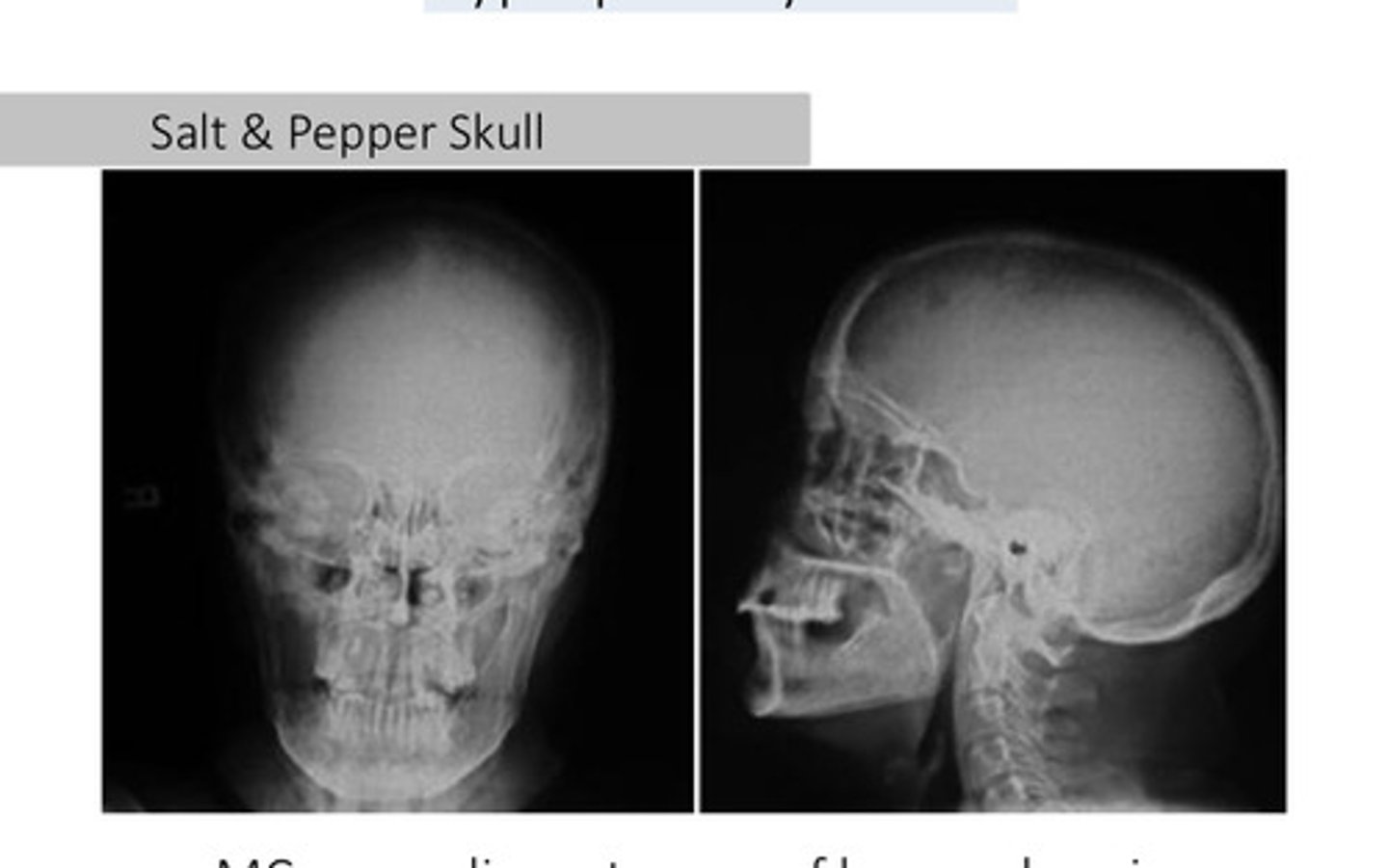 <p>Hyperparathyroidism</p>