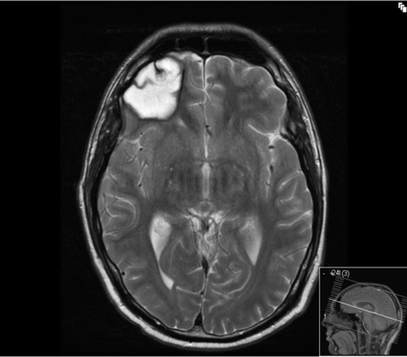 <p>tomografía computarizada</p>