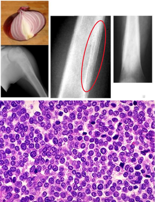 <p>the second most common group of bone sarcomas in children that usually arise in the <strong><span style="color: red">diaphysis or long tubular bones, especially the femur &amp; the flat bones of the pelvis</span></strong></p><ul><li><p><strong><mark data-color="red">primitive neuroectodermal tumor (PNET) associated with t(11;22)</mark></strong></p></li><li><p><strong><mark data-color="blue">rapidly growing &amp; arises in the </mark><span style="color: red"><mark data-color="blue">medullary cavity extending to the cortex, periosteum, &amp; soft tissue</mark></span></strong></p></li></ul><p>clinical presentation</p><ul><li><p><strong><mark data-color="green">typically occurs between ages 10 - 15</mark></strong></p></li><li><p><strong><mark data-color="blue">produces “onion skin layering“ on x-ray</mark></strong></p></li><li><p><strong>composed of sheets of uniform small, round cells with scant cytoplasm</strong></p></li><li><p>presents as<strong><mark data-color="blue"> painful enlarging masses &amp; the affected site is frequently tender, warm, &amp; swollen</mark></strong></p></li><li><p>may have systematic findings, including<strong><mark data-color="blue"> fever, elevated sedimentation rate, anemia, &amp; leukocytosis which mimic infection (osteomyelitis)</mark></strong></p></li></ul><p>treatment</p><ul><li><p><strong><mark data-color="purple">neoadjuvant chemotherapy followed by surgical excision with or without irradiation</mark></strong></p></li><li><p>5-year survival rate 75% with aggressive therapy</p></li><li><p>scenario → give antibiotics &amp; no improvement</p></li></ul>