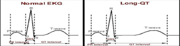 <p><strong>Normal QT Interval:</strong></p><ul><li><p class="">0.35 to 0.45 seconds</p></li></ul><p><strong>Genetic/Inherited Causes:</strong></p><ul><li><p class=""><u>QT &gt; 0.50 seconds</u></p></li><li><p class="">A common cause of cardiac arrest among young people</p></li><li><p class="">Often underdiagnosed</p></li><li><p class="">Genetic testing is available</p></li></ul><p><strong>Acquired Causes:</strong></p><ul><li><p class=""><strong>Drug-induced</strong>: Over 75 drugs can prolong the QT interval</p></li></ul><p><strong>Possible Contributors to Prolonged QT:</strong></p><ul><li><p class="">Electrolyte imbalance</p></li><li><p class="">Hypothermia</p></li><li><p class="">Structural heart disease</p></li><li><p class="">Female gender</p></li><li><p class="">Abnormal thyroid function</p></li></ul><p><strong>Signs &amp; Symptoms:</strong></p><ul><li><p class="">Syncope</p></li><li><p class="">Seizures</p></li><li><p class="">Sudden death</p></li></ul><p><strong>Treatment:</strong></p><ul><li><p class="">Eliminate medications that may contribute</p></li><li><p class="">Potassium supplements</p></li><li><p class="">Implantable Cardiac Defibrillator (ICD)</p></li><li><p class="">Mexiletine (oral analog to Lidocaine)</p></li><li><p class="">Beta-blockers (Shorten the QT interval)</p></li></ul><p></p>