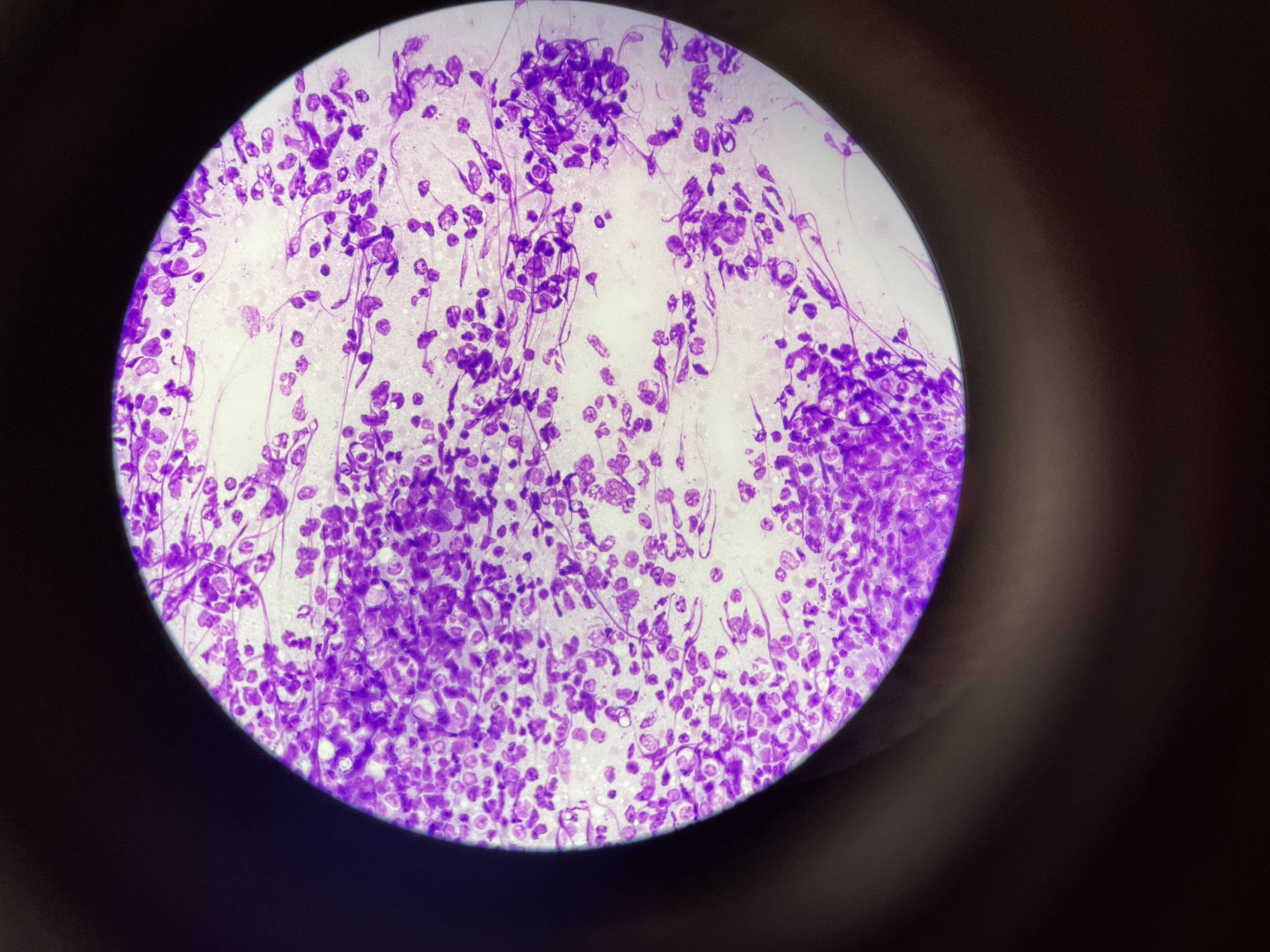 <ul><li><p>Chagas Disease</p></li><li><p>Latin America Disease</p></li><li><p>Spleen (second pic)</p></li><li><p>Blood smear(first pic)</p></li></ul>
