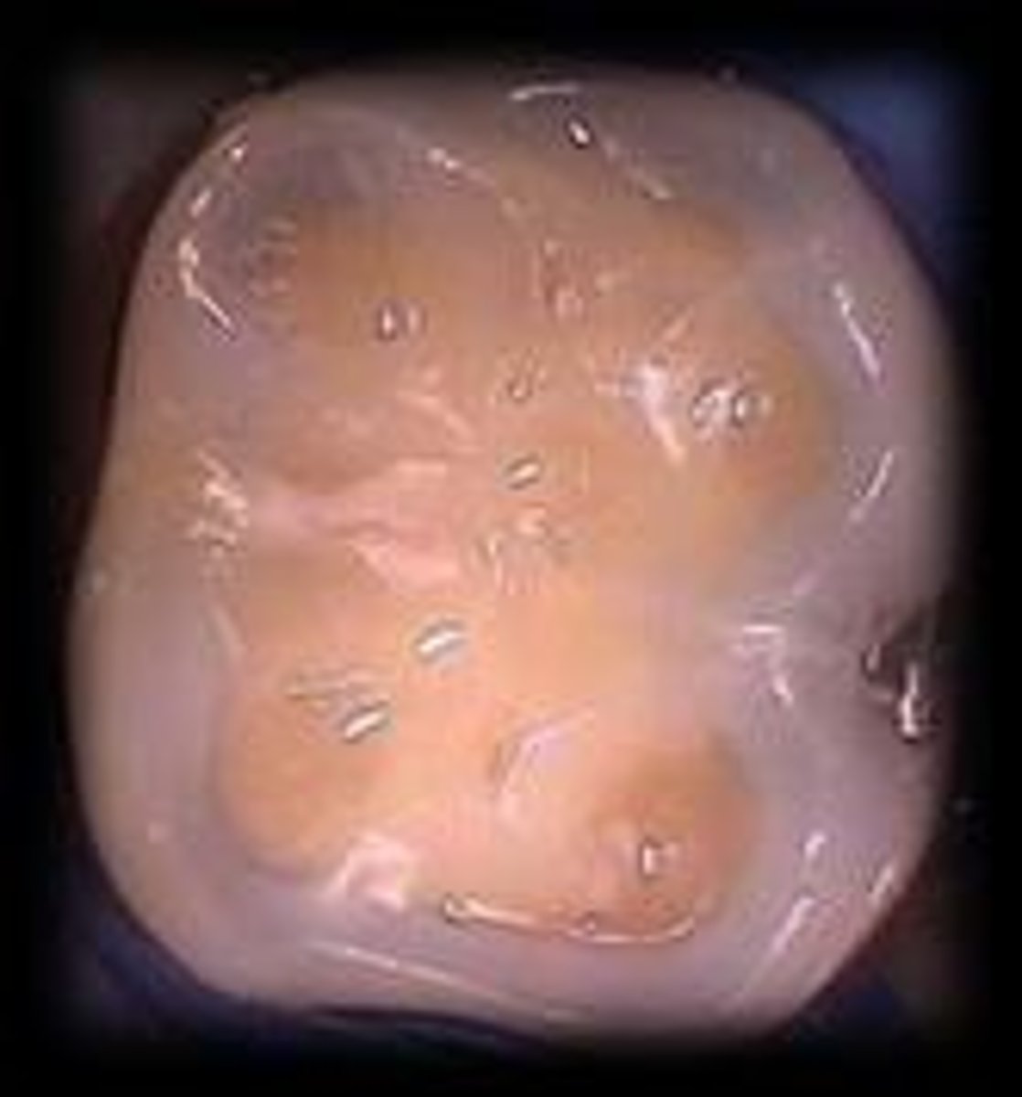 <p>Loss of tooth structure through chemical means, leading to broad concavities within smooth surface enamel.</p>