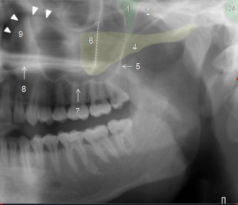 <p>Identify The Structures On The Maxillary, Temporal &amp; Zygomatic Structures.</p>
