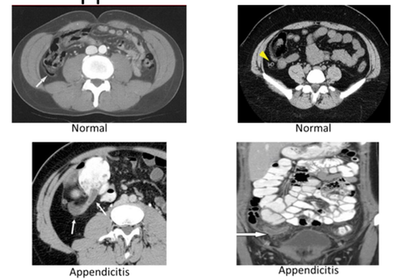 <p>CT- diagnostic study of choice in adults, dilated appendix that does not fill w oral contrast, periappendiceal inflammation, increased contrast enhancement of wall, perforation</p><p>US- diagnostic study of choice in pediatric pts</p>