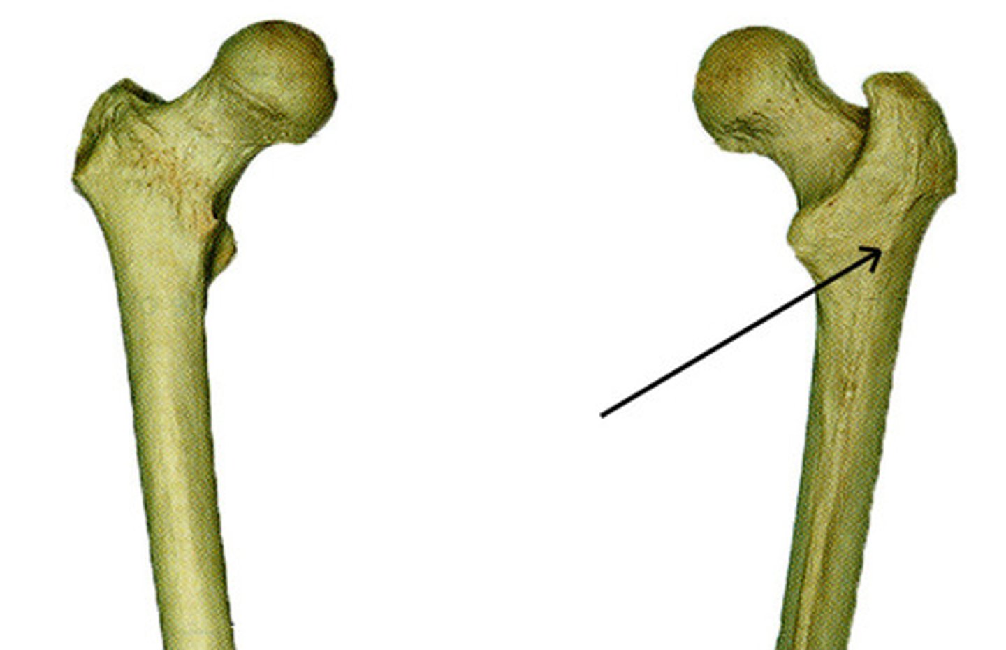 <p>back of femur; bump above the linea aspera that is on the upper portion of femur</p>