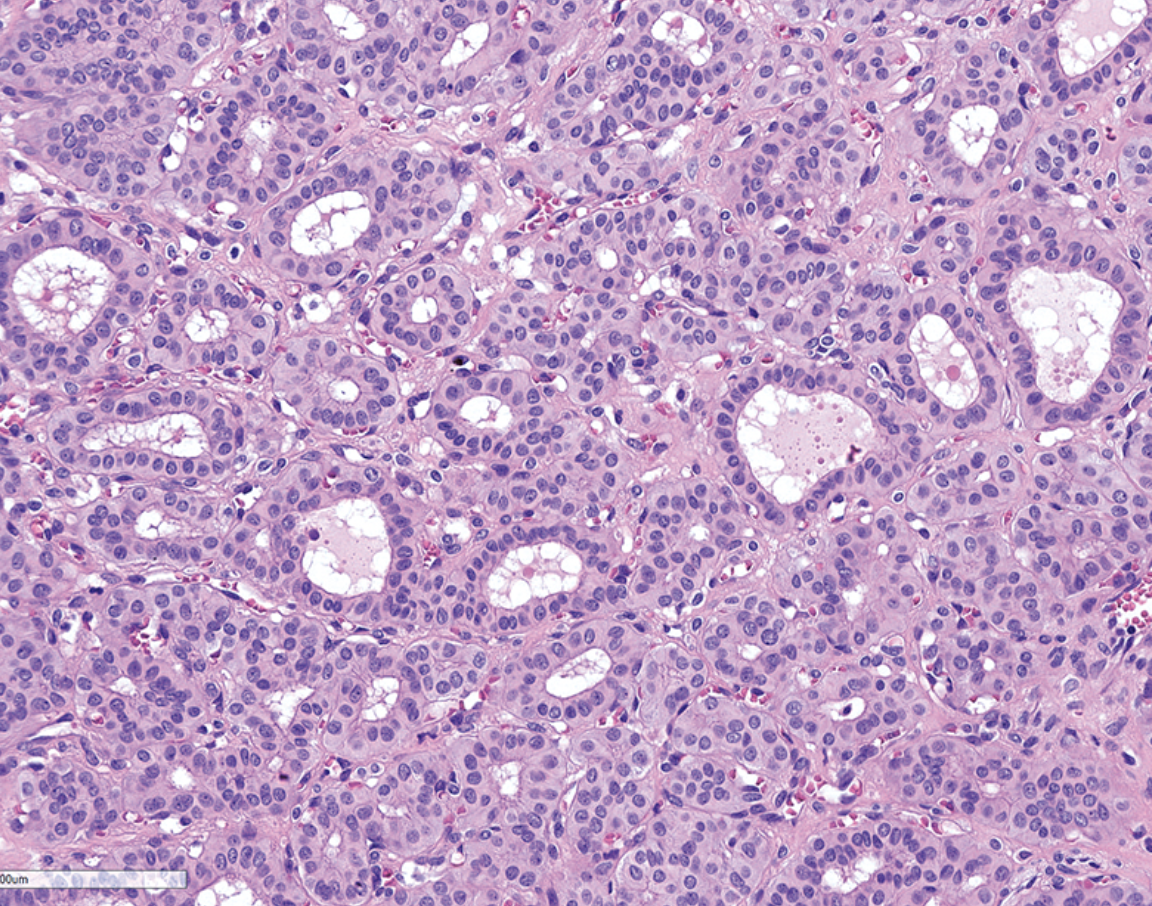 <p>Homme de 40 ans avec lésion parotide </p><p>1) Diagnostic </p><p>2) Epidemio (age, pronostique, localisation)</p><p>3) Histologie</p><p>4) IHC</p><p>5) Moléculaire </p><p></p>