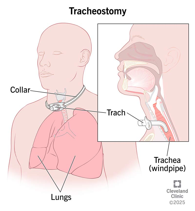 <ul><li><p>Placed into the trachea via a surgical incision</p></li><li><p>Used for long-term airway support</p><ul><li><p><strong>Permits long-term MV (over 10-14 days)</strong></p></li><li><p>Facilitates weaning from MV</p></li></ul></li><li><p>Used for <strong>urgent airway needs when oral or nasal intubation is not possible</strong></p><ul><li><p>Bypasses upper airway obstruction</p></li><li><p>Facilitates secretion removal</p></li></ul></li></ul><p></p>
