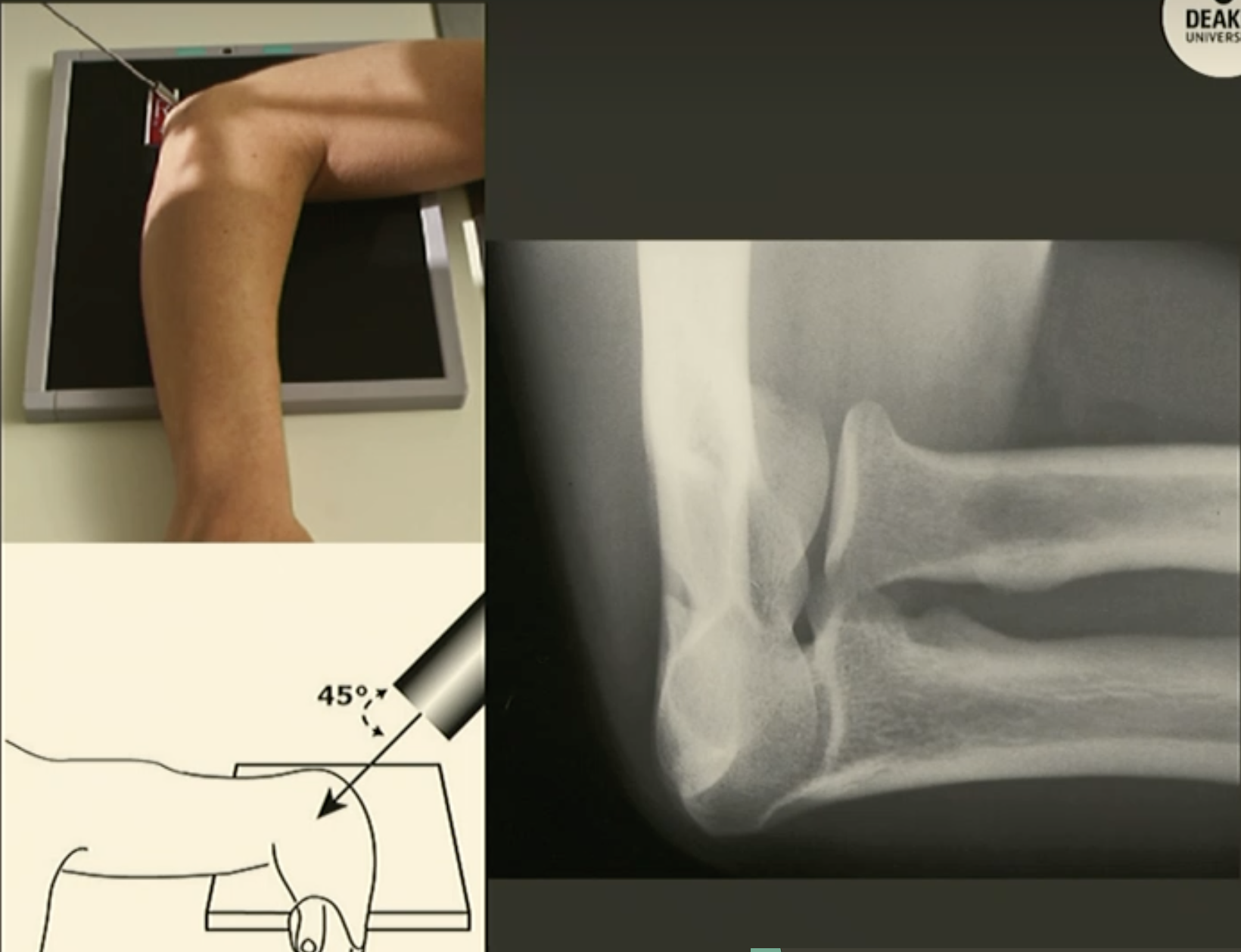 <p>Fine FS, 100cm</p><p>60kVp/3mAs</p><p>Tube angle 35-45 degrees towards humerus</p><p>CR: Radial head</p>