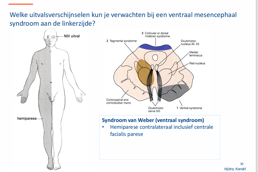 <p>Oorzaak: tumor corpus pineale.</p>