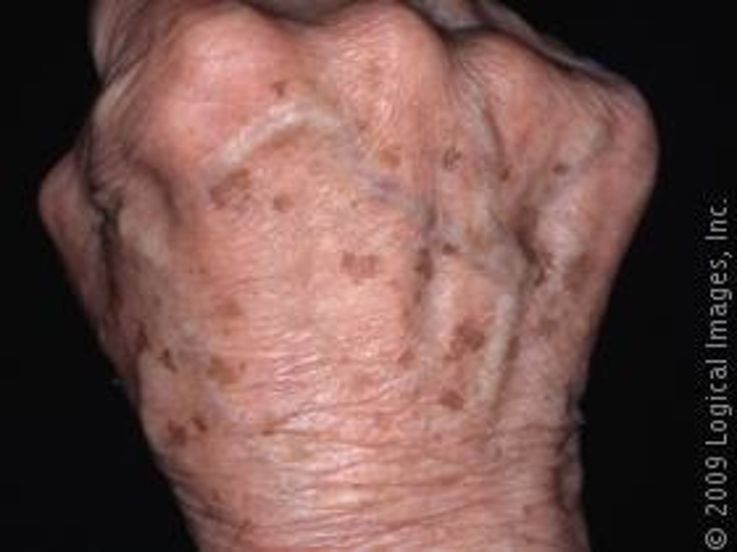<p>- Skin wrinkles, becomes lax, and dries out</p><p>- Skin becomes thin and fragile</p><p>- Veins enlarge</p><p>- Nails lose their luster and may yellow and thicken</p>