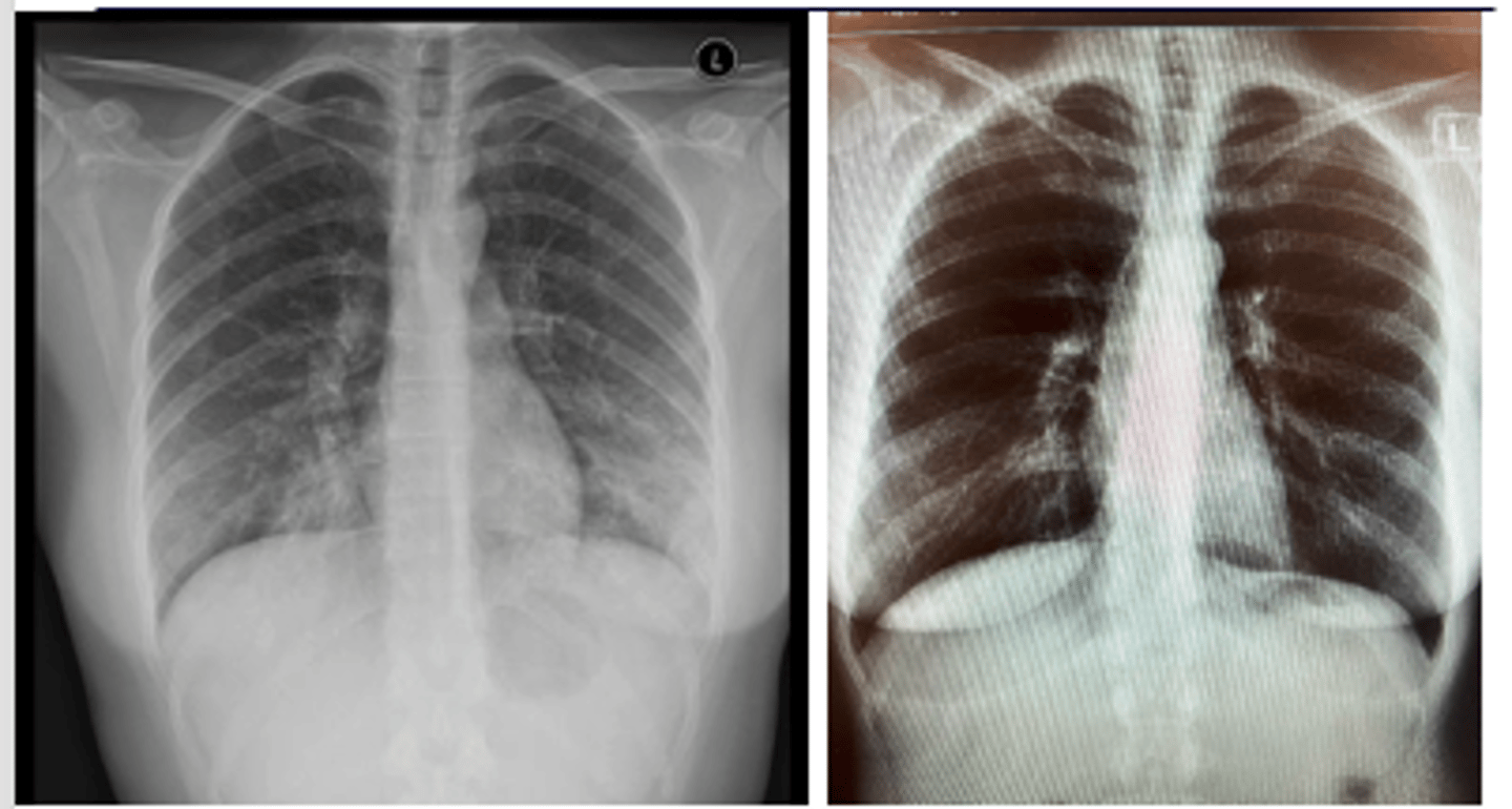 <p>Pneumonias that are interstitial and symmetrically diffuse in both lungs</p><p>Path: mycoplasma</p>
