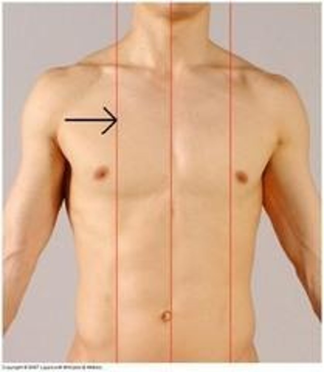 <p>imaginary vertical line bisecting the middle of the clavicle in each hemithorax</p>