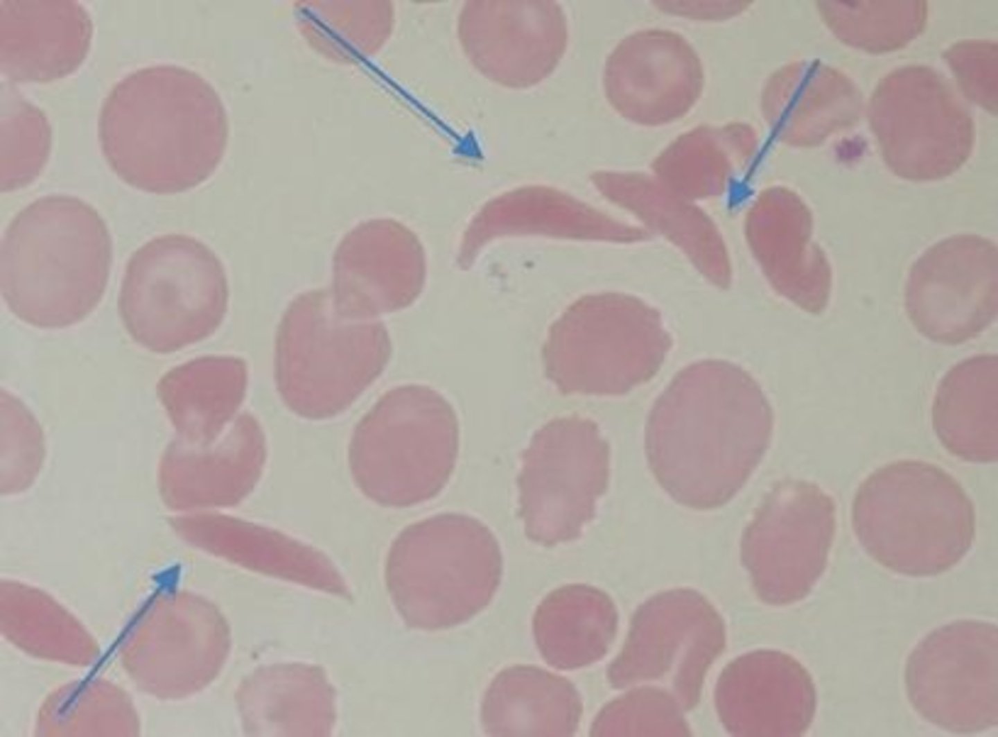 <p><strong><mark data-color="yellow" style="background-color: yellow; color: inherit;">Sickle cell disorders (Sickle Cell Anemia</mark></strong>) is only inherited and needs to have hemoglobin S </p>