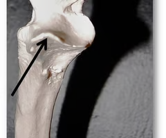 <p>Coronoid process of ulna</p>