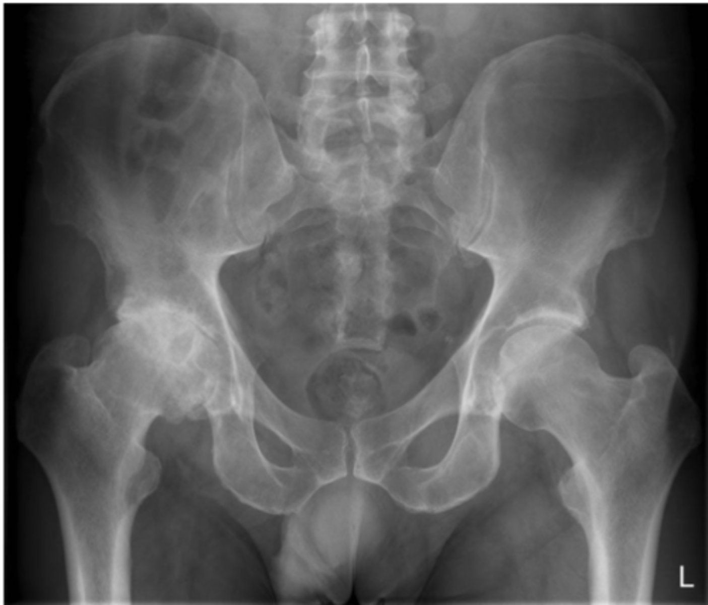 <p>Which femur rotation was present for this projection</p>