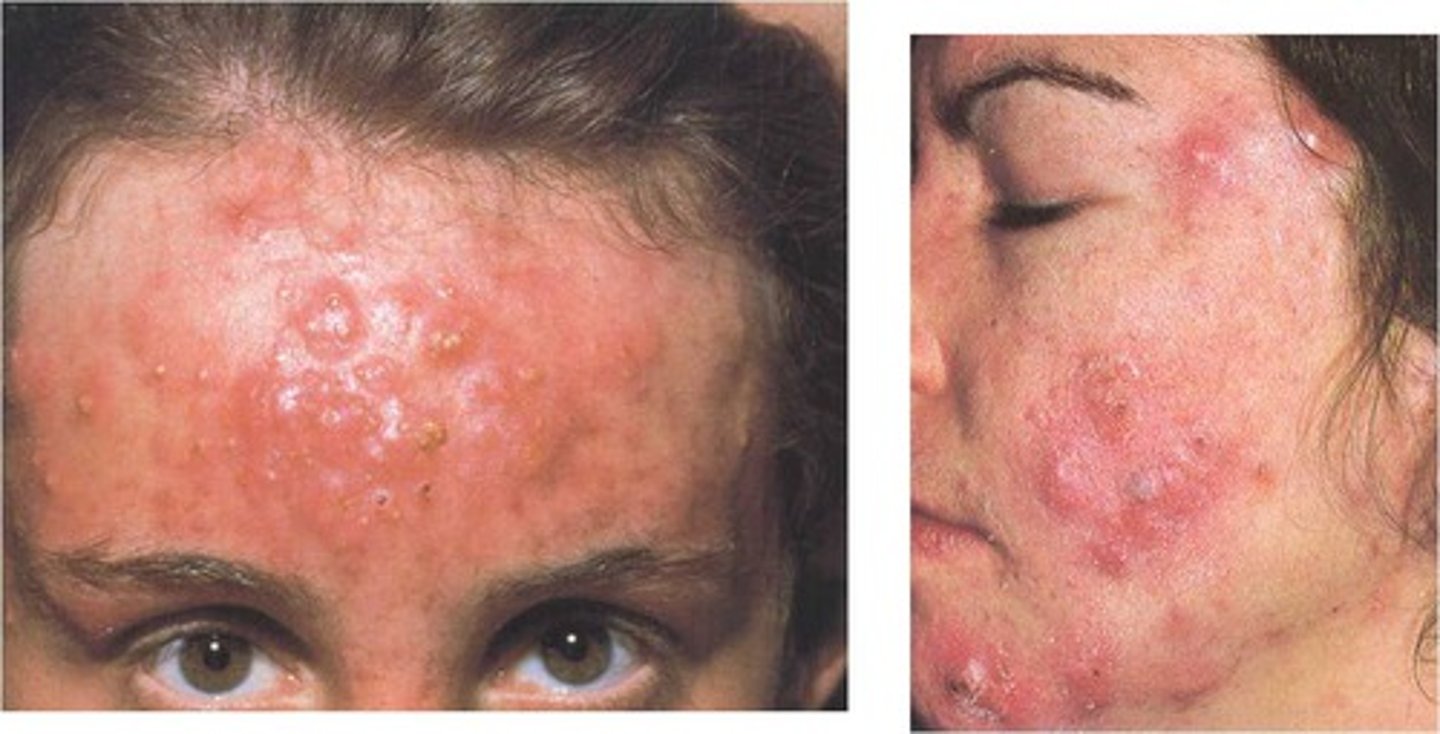 <p>a cyst of connective tissue that forms due to infection of sebaceous glands that requires aggressive treatment</p>