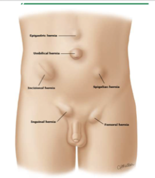 <p>A protrusion, bulge, or projection of an organ/part of an organ through weak spots on the abdominal or pelvic wall - second most common cause of bowel obstruction</p>