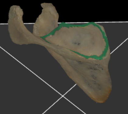 <p>gans het gebied boven de spina scapulae op de facies posterior</p>