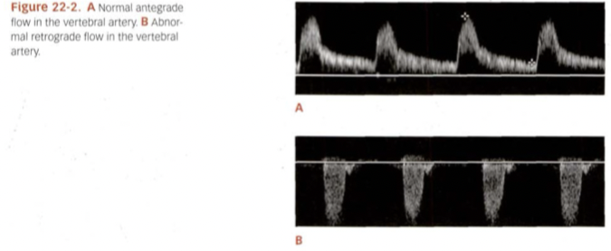 <p>What type of flow, resistance going which direction for A?</p>