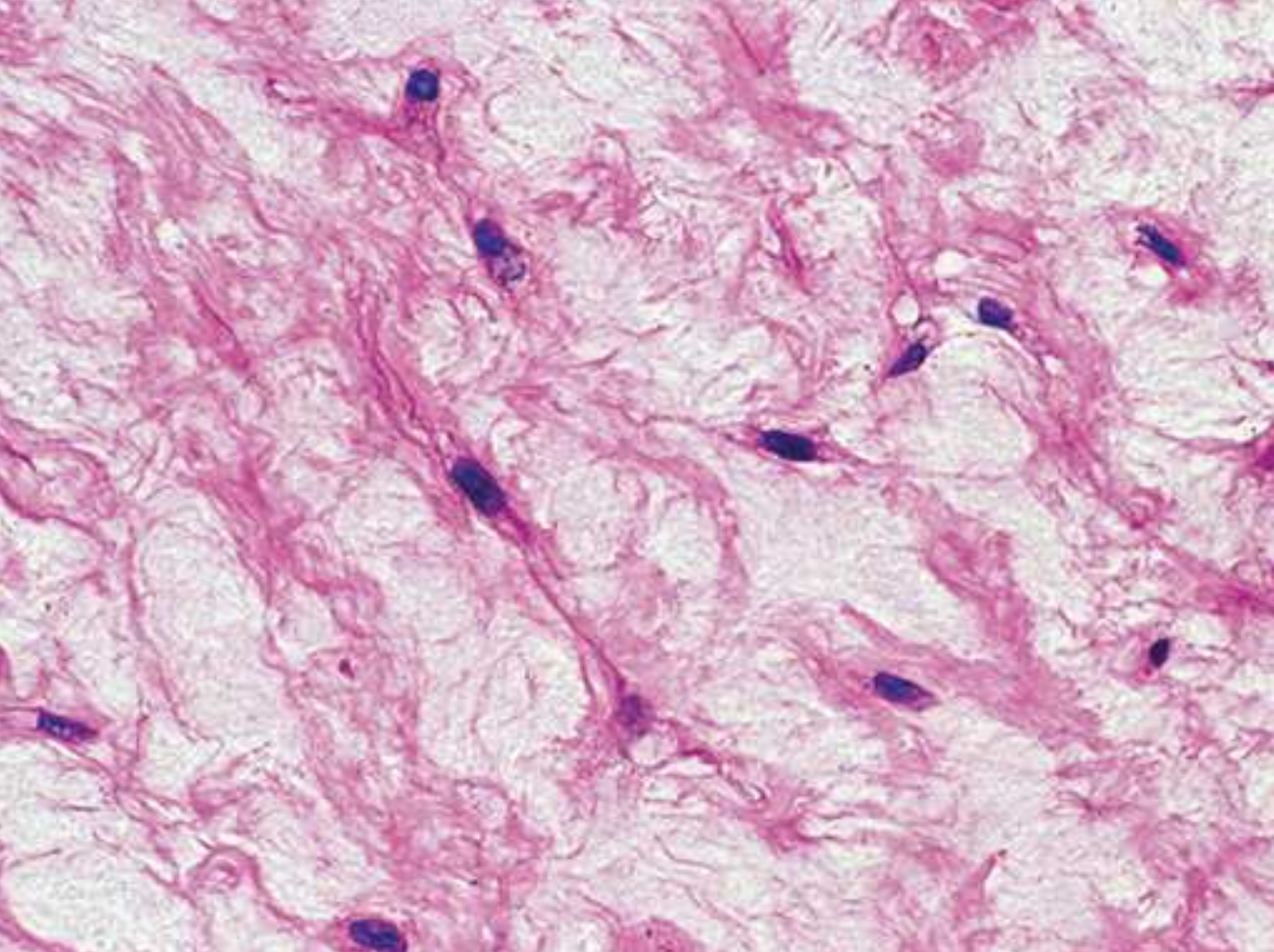 <p>Mucoid (mucous) tissue</p>