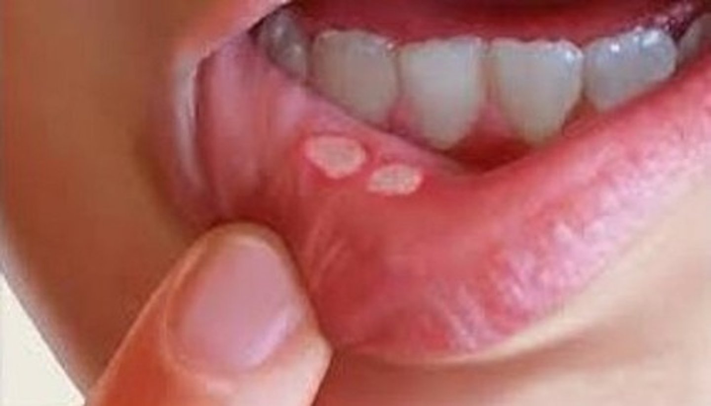 <p>a break in the skin or on the surface of an organ inside the body, which does not heal naturally: Loét miệng</p><p>Synonyms: Canker sore, oral ulcer</p><p>Example: She developed a painful mouth ulcer after accidentally biting her lip</p>