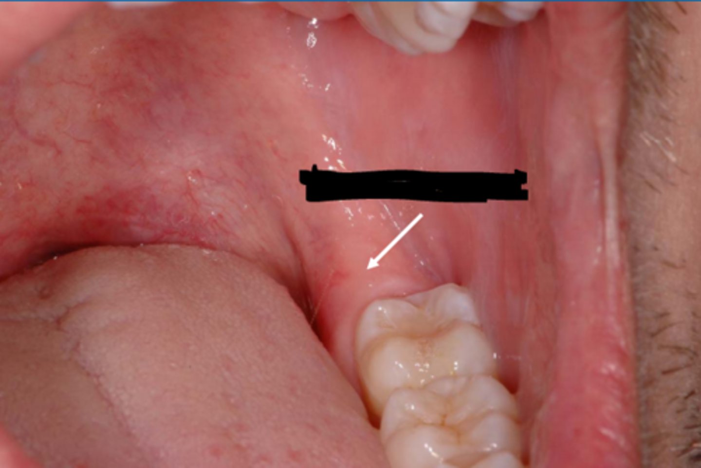 <p>glandular tissue, loose areolar connective tissue, the lower margin of the pterygomandibular raphe, fiber of the buccinator and superior constrictor and fibers of the temporal tendon.</p>