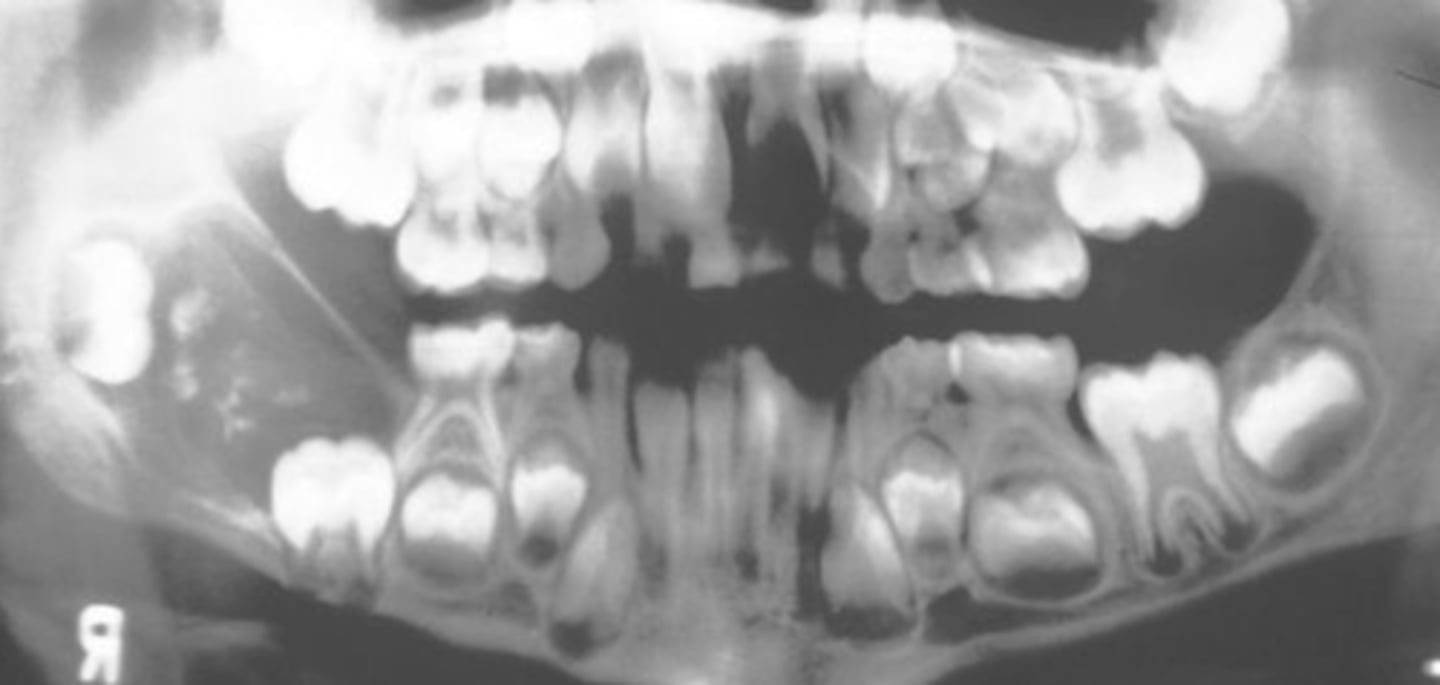 <p>• asymptomatic</p><p>• usually associated with impacted tooth</p>