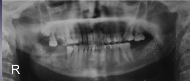 <p>what’s the pathology of the R mandible </p>