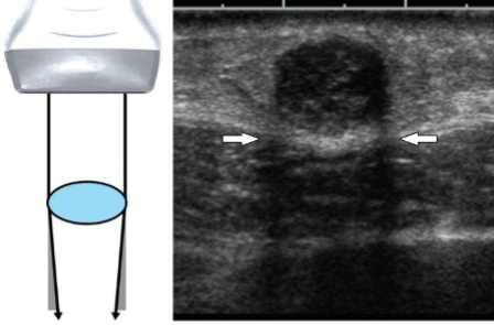 <ul><li><p><span style="background-color: transparent;">Type of refraction artifact</span></p></li><li><p><span style="background-color: transparent;">Caused by a combination of reflection and refraction at the margin of a well-defined object</span></p><ul><li><p><span style="background-color: transparent;">The beam is being bent because of refraction and because of attenuation in the area next to the bent beam, we end up with the shadow as shown in the diagram</span></p></li></ul></li><li><p><span style="background-color: transparent;">Appears as a shadow originating from the edge of a structure</span></p></li><li><p><span style="background-color: transparent;">Reduced with spatial compounding</span></p><ul><li><p><span style="background-color: transparent;">…because spatial compounding takes different averages/different frames of the beam shot at different angles. So, we’re actually able to angle the beam behind the structure and area that causes the refraction to help reduce those shadows.</span></p></li></ul></li></ul><p></p>