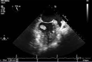 <p>Papillary fibroelastoma</p>