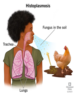 <p>Histoplasmosis (fungal disease)</p>