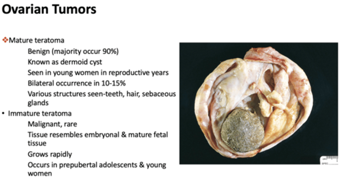 <p>mature teratoma</p>