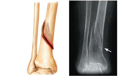 <p>Ragged break occurs when excessive twisting forces are applied to a bone</p>
