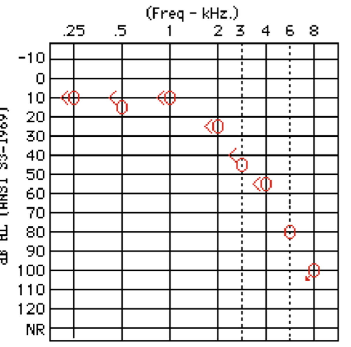 <p>500 Hz = 15 dB HL</p><p>1000 Hz = 10 dB HL </p><p>2000 Hz = 25 dB HL</p><p>4000 Hz = 55 dB HL</p><p>PTA? </p><p>HFPTA?</p><p>answer:</p><p>(PTA = 16.7 dB HL) - slight hearing loss</p><p>(HFPTA = 26.25 dB HL) - mild hearing loss</p>