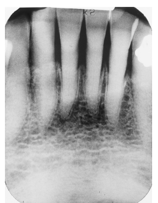 <p><span><span>This patient is a 72-year-old man. Notice that the pulp and root canal spaces are significantly diminished. What is the cause of this?</span></span></p><p>&nbsp;</p><p>attrition and age</p><p>&nbsp;</p><p>floss injury</p><p>&nbsp;</p><p>pulp stones</p><p>&nbsp;</p><p>erosion</p>