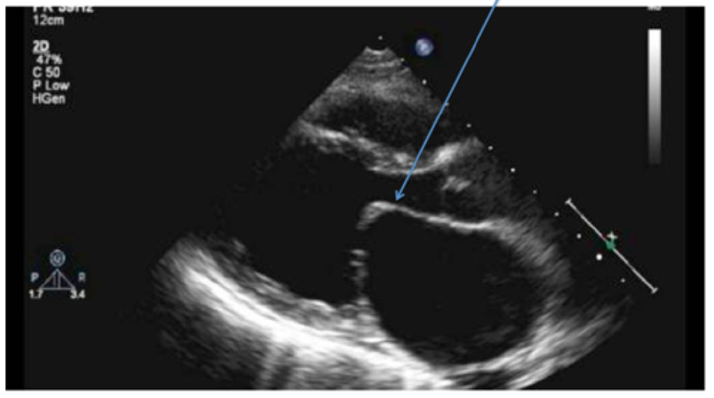 <p>narrowing of the MV orifice with bright band of echoes in 2D and M-mode; thickening of AML and PML with anterior motion of PML; LA dilation and increased pressure; hockey puck appearance; decreased E-F slope and D-E excursion with diastolic doming</p>