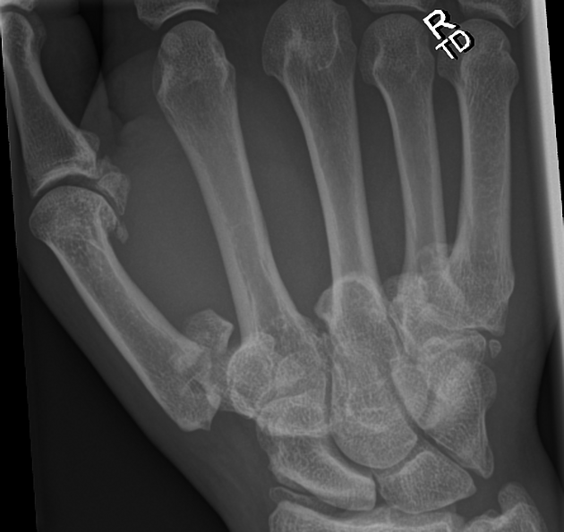 <p>What type of fracture is this? </p>