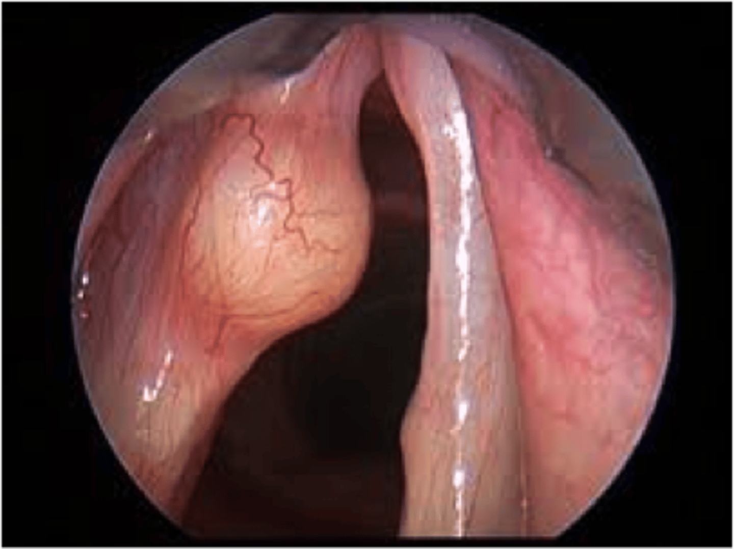 <p>Fluid filled sac interfere with free motion of outer layer of vocal folds</p>