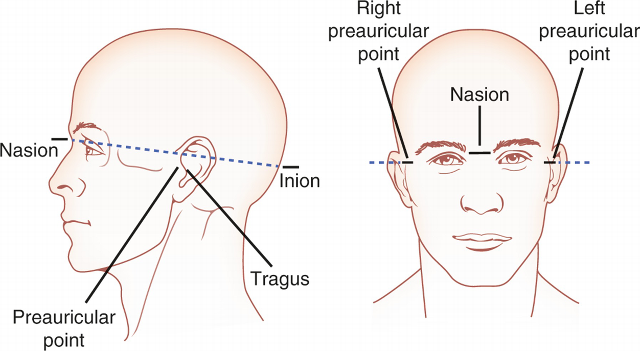 <p>Nasion; inion; Rt and Lt preauricular</p>